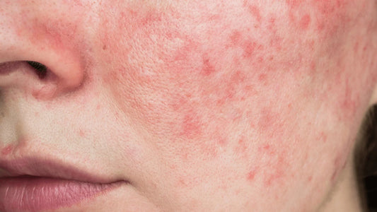 Geschädigte Hautbarriere: Anzeichen, Ursachen und die besten K-Beauty Tipps zur Heilung